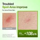 Anua Azelaic Acid 10 Hyaluron Redness Soothing Serum 1.01 fl.oz - Facial Serum for Blemish-Prone & Oily-Prone Skin 4