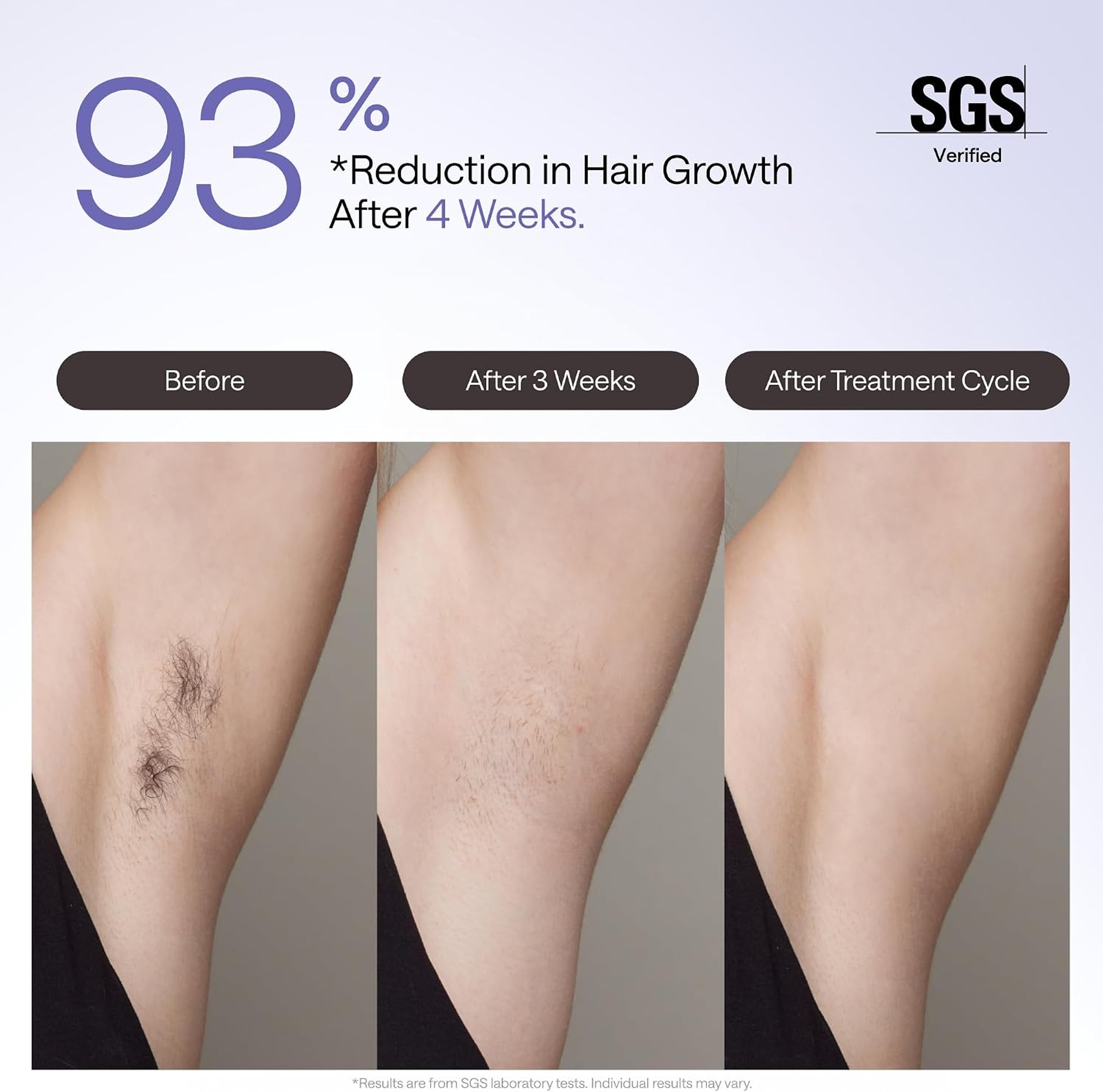 Ulike Air 4 IPL Laser Hair Removal Device - Ice Cool and Permanent Hair Reduction for Women & Men 2