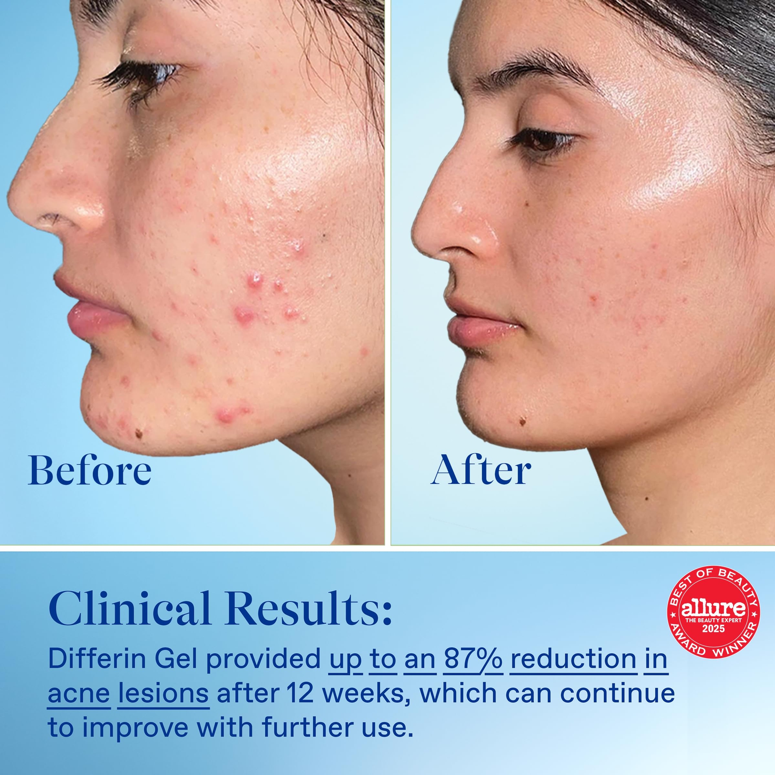 Differin Adapalene Gel 1.6 oz (Pump) - Retinoid Acne Treatment for Face with 0.1% Adapalene 6