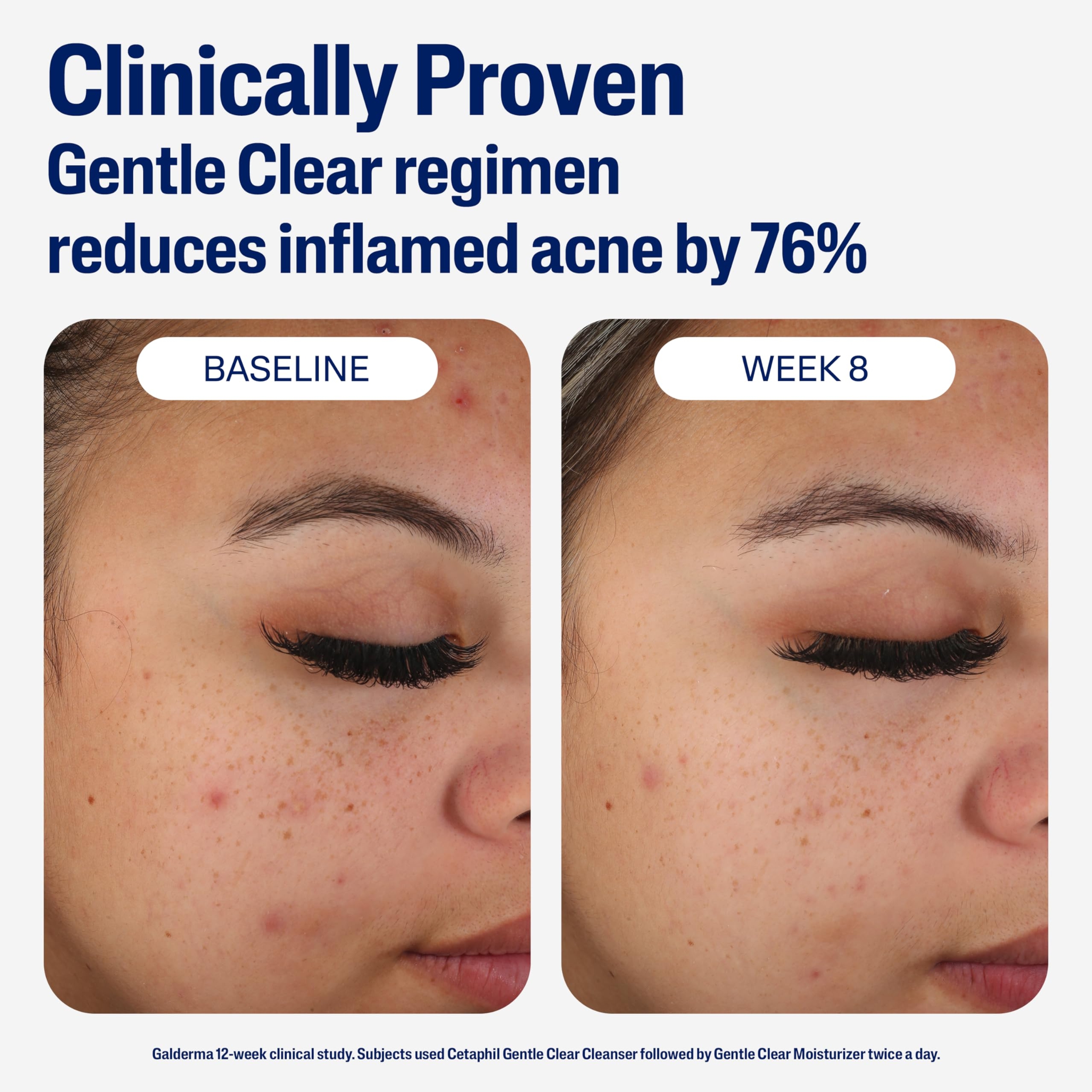 Cetaphil Gentle Clear Mattifying Acne Moisturizer 3 fl.oz - with 0.5% Salicylic Acid for Acne-Prone, Sensitive skin 7