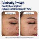 Cetaphil Gentle Clear Mattifying Acne Moisturizer 3 fl.oz - with 0.5% Salicylic Acid for Acne-Prone, Sensitive skin 7