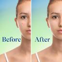Differin Acne Foaming Cleanser 5 fl.oz - Acne Face Wash with 10% Benzoyl Peroxide for Face & Body 6