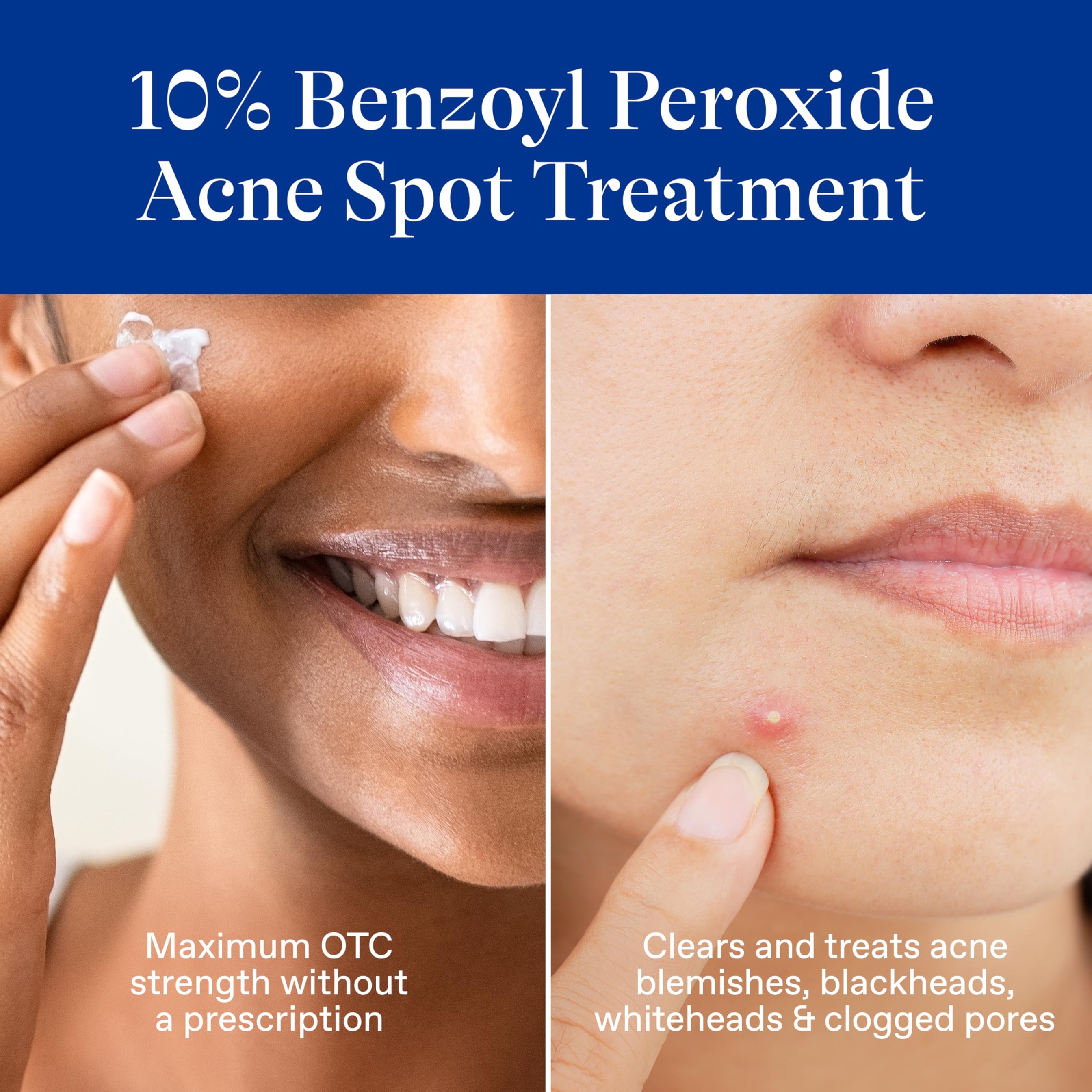 Differin 10% Benzoyl Peroxide Spot Treatment 1 oz - Fast-Acting Pimple Treatment, Clears Acne Overnight 2