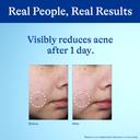 Differin 10% Benzoyl Peroxide Spot Treatment 1 oz - Fast-Acting Pimple Treatment, Clears Acne Overnight 4