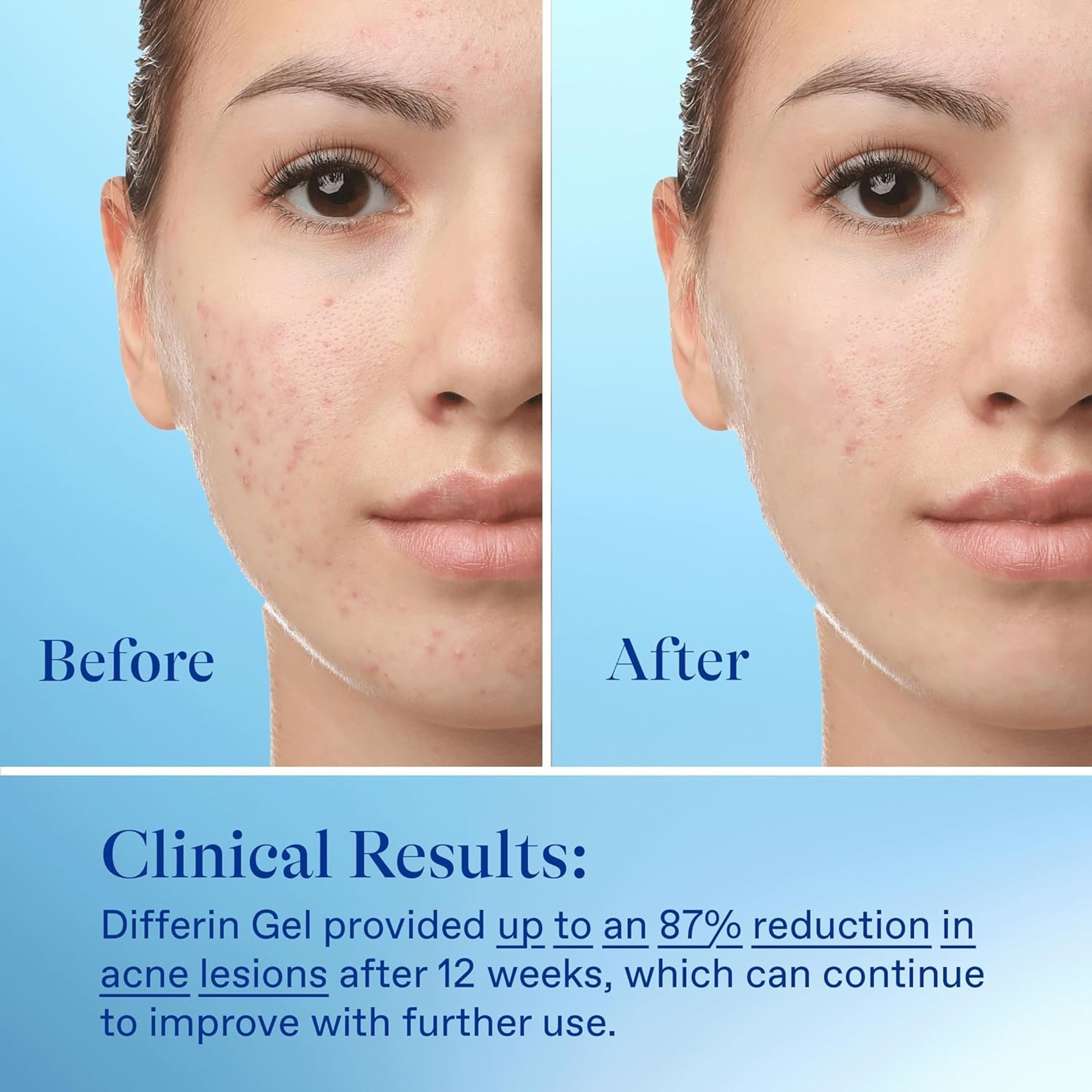Differin Adapalene Gel 0.5 oz (Tube) - Retinoid Acne Treatment for Face with 0.1% Adapalene 9