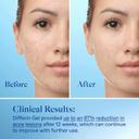 Differin Adapalene Gel 0.5 oz (Tube) - Retinoid Acne Treatment for Face with 0.1% Adapalene 9