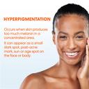 Palmer's Anti-Dark Spot Fade Cream 2.7 oz - Helps Reduce Dark Spots, Evens Skin Tone for All Skin Types 5