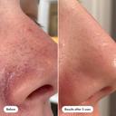Hero Cosmetics Pore Release Blackhead Clearing Solution 3.38 fl.oz - 2% Salicylic Acid Blackhead Remover Toner 5