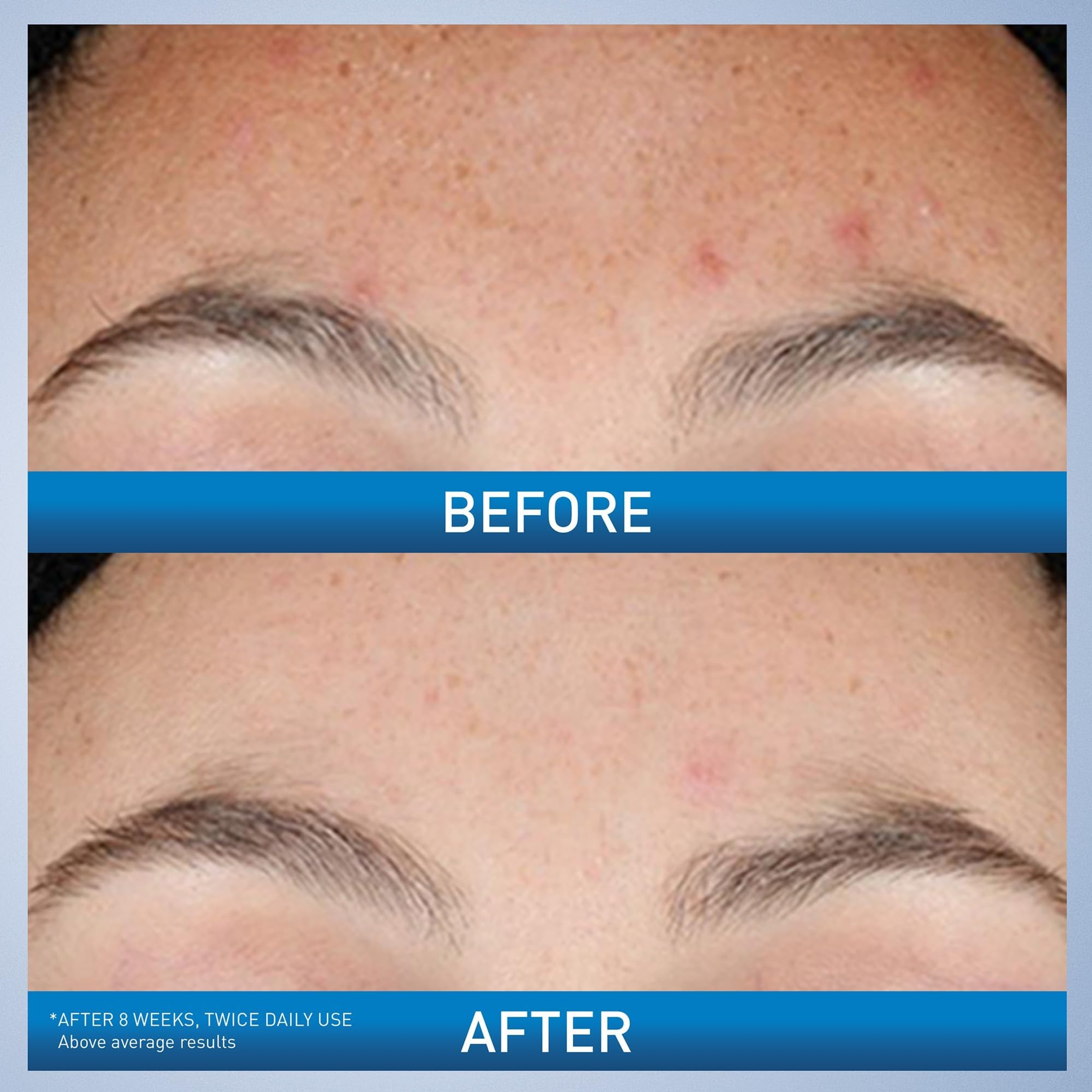 CeraVe Resurfacing Retinol Serum For Post Acne Marks, Formulated With Licorice Root Extract & Niacinamide, Brightening Serum & Pore Minimizer For Face, Post Acne Skin Barrier Repair, Non-Comedogenic 3