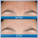 CeraVe Resurfacing Retinol Serum For Post Acne Marks, Formulated With Licorice Root Extract & Niacinamide, Brightening Serum & Pore Minimizer For Face, Post Acne Skin Barrier Repair, Non-Comedogenic 3