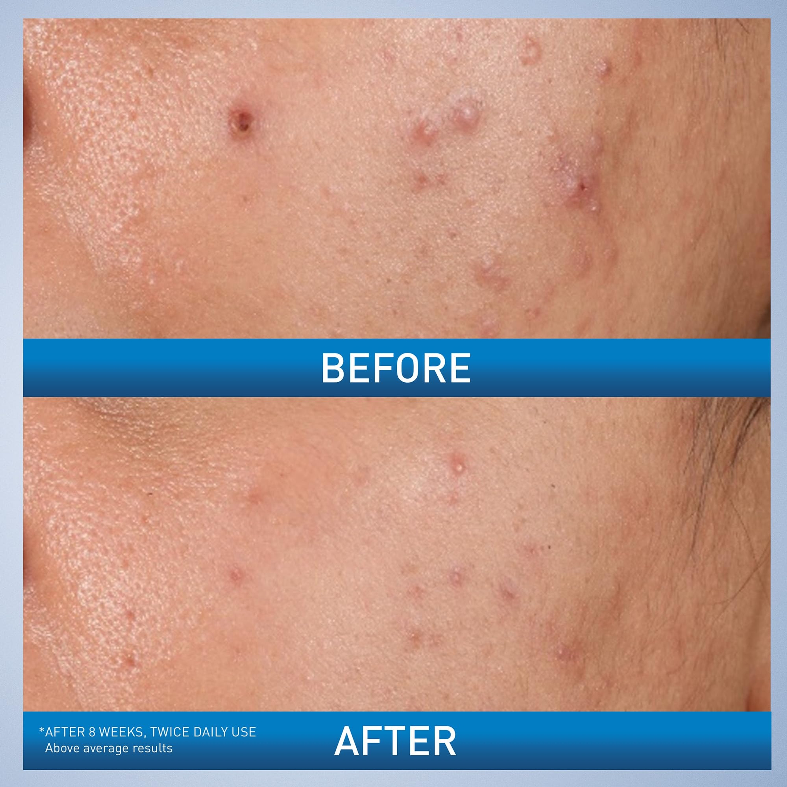 CeraVe Acne Control Gel, 2% Salicylic Acid Treatment With Glycolic Acid + Lactic Acids + Niacniamide, Acne Gel Helps Clear Blemishes Without Over Drying, Alcohol Free & Oil Free, 1.35 Fl Oz 2