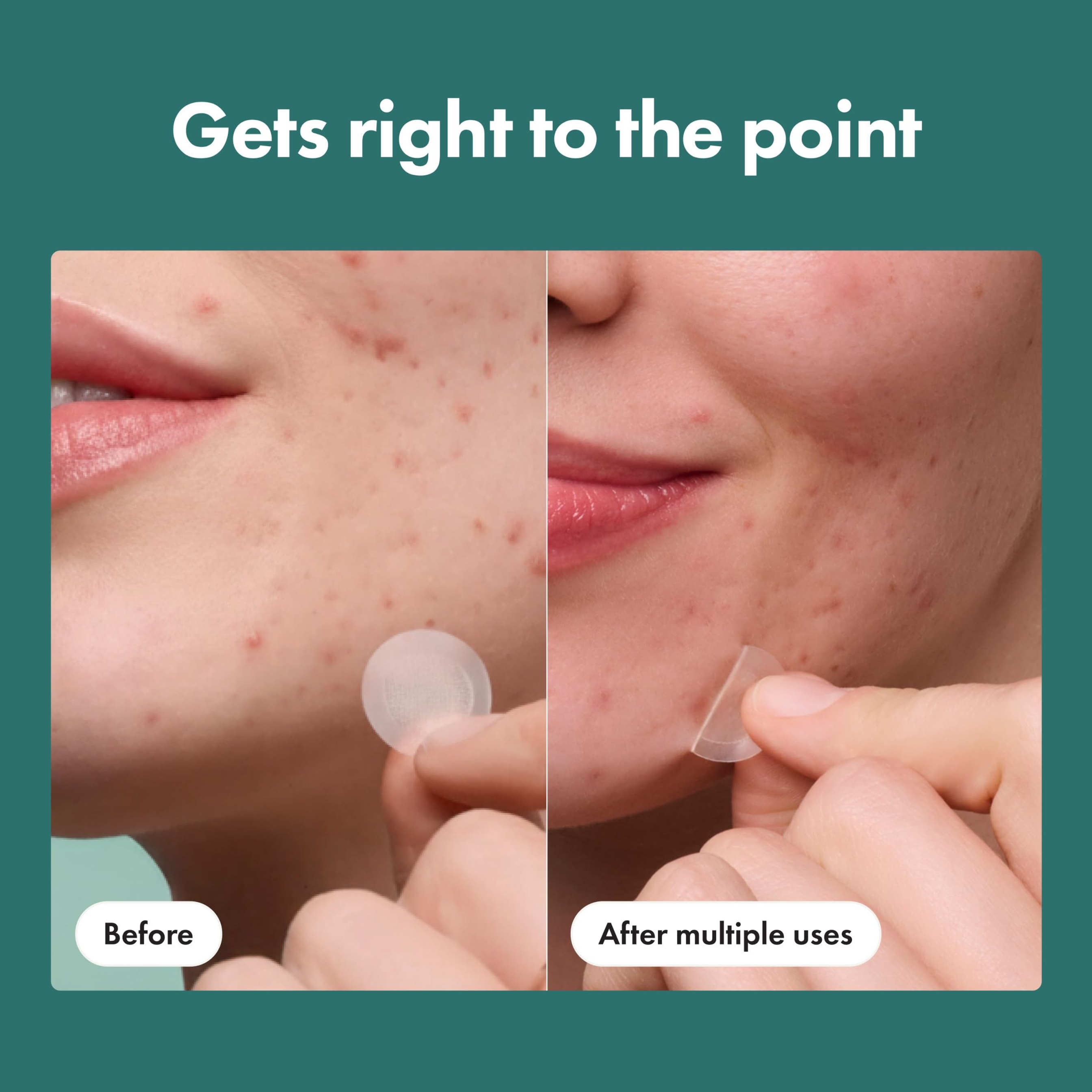 Mighty Patch Hero Cosmetics for Early-Stage Blemishes 8 Count - Micropoint Acne Pimple Patch 6