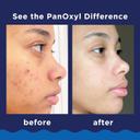 PanOxyl Acne Foaming Wash 5.5 oz - Daily Acne-Fighting Cleanser with 10% Benzoyl Peroxide, Maximum Strength 4